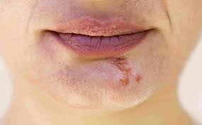 A cold sore (oral herpes) and a pimple on the lip can both cause lip bumps that look the same. Is It A Cold Sore Or Pimple