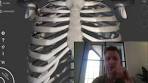 Syndroom van Tietze - YouTube