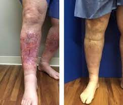 Sclerotherapy In Traverse City Cadillac Mi