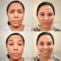 Centro Médico List: conociendo el botox