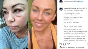 Michelle Heaton posts graphic photo of alcohol addiction