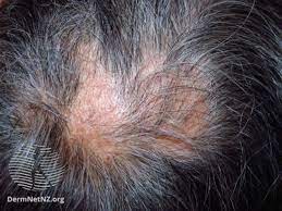 Gluten which is found in wheat may be linked to certain. The Connection Between Celiac Disease And Hair Loss