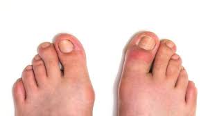 Maybe you would like to learn more about one of these? Jempol Kaki Bengkak Ini 8 Penyebab Dan Cara Mengatasinya
