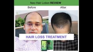 We did not find results for: Neo Hair Lotion I 100 Effective Neo Hair Lotion For Hair Growing Oil World Best Solution
