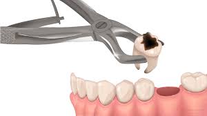 Image result for Alveolitis sicca)