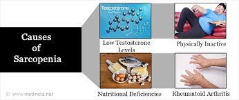 Progressive decline in muscle mass due to aging. Sarcopenia Causes Symptoms Diagnosis Complications Treatment Prevention