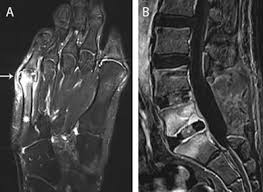 Image result for Osteomyelitis XRay