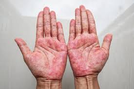 Image result for contact dermatitis
