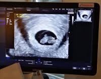 Sehen sie, wie sich ihr baby entwickelt. Kein Herzschlag Was Nun Forum Schwangerschaft Urbia De