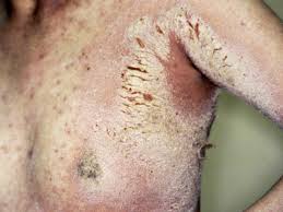 Image result for scabies norvegica