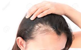 Dans le cas de la perte de cheveux localisée, seule une zone de votre tête est touchée. Ø¥ÙØ¨Ø±Ø§Ø·ÙØ±ÙØ© Ø§ÙÙØªØ¨ÙÙ Ø®ÙÙØ· Soin Perte De Cheveux Femme Cartersguesthouses Com