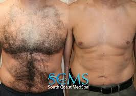 Afterwards, laser hair removal is permanent on most areas of the body. Laser Hair Removal For Men Los Angeles Orange County Virtually Pain Free Chest Hair Removal Back Hair Removal Facial Hair Removal Leg And Bikini Hair Removal