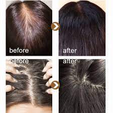 There are plenty of ways to help hair grow faster and longer—diet, vitamins, and even the shampoo you use can all affect hair thickness and health. 20ml Hair Growth Essence Liquid Help Hair Growing Anti Hairs Loss Nourishing Essences For Hair Care 998 Hair Scalp Treatments Aliexpress