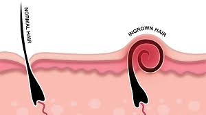 Ingrown hairs are hairs that curl and grow back into your skin after shaving or waxing. Ingrown Hair What S Going On Under My Skin Peach Clinics