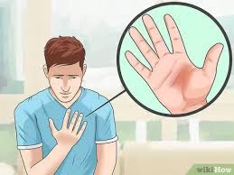 We did not find results for: How To Take The Sting Out Of A Burn With Pictures Wikihow
