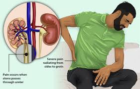 Kidney Stones The Portugal News