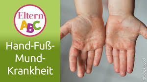 Hand Fuss Mund Krankheit Symptome Und Dauer Eltern De