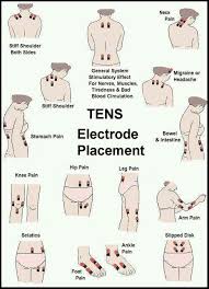 Tens Electrode Placement Tens Unit Therapy Fibromyalgia Tens Electrode Placement