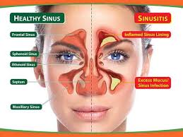 Sinus Infection With Images Home Remedies For Sinus Sinus Infection Remedies Cure Sinus Infection Naturally