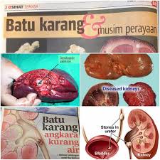 Proses pengeluaran batu karang seperti di bawah. Rawatan Batu Karang Yang Lebih Murah Dari Pembedahan Pengedar Shaklee Shah Alam