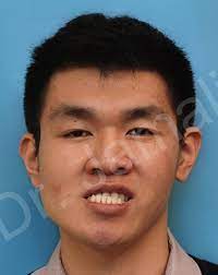 Crooked Chin Dr Majid Jamali Oms Of Ny