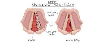 Hoarse definition, having a vocal tone characterized by weakness of intensity and excessive breathiness; London Ent Associates Voice And Hoarseness