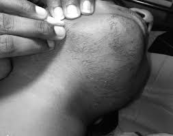 It seems to be growing pretty evenly and very fast. Hirsutism Unwanted Male Pattern Hair Growth Syndrome Lase Acadamea