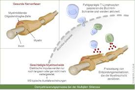 Multiple sclerosis (ms) is a nerve disease that reaches its peak in the senior years of life. Demyelinisierungsprozess Bei Der Erkrankung Multiple Sklerose Multiple Sklerose Sklerose Erkrankungen