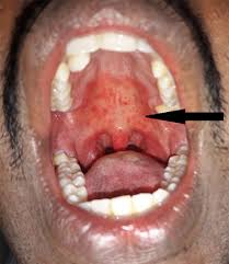 Image result for Erythroplakia roof of mouth