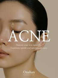 Acne | ONAHAN The Acne Treatment Program of Onahan Clinic combines  traditional Korean herbal medicine with advanced dermatological care to  provide a refined and results-oriented solution for acne-prone skin.  Designed to treat