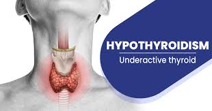 Hypothyroidism Symptoms - Causes, Diagnosis & Treatment | Max Lab