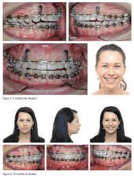 Braces can be another way to fix a gummy smile, depending on the cause of your gummy smile. Gummy Smile An Often Untreated Condition Orthodontic Practice Us
