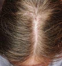 Over the summer i got my hair colored blonde and while i like to change as few variables as possible while reviewing products (i had been using the hair serum for 3 weeks before going blonde). Review Will The Ordinary S Multi Peptide Serum Increase Hair Density An Introvert Talks