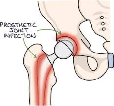 Image result for Septic Joint