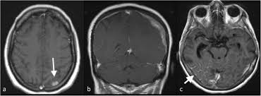 Ct scans do not have these problems; Imaging Diagnosis Of Metastatic Breast Cancer Insights Into Imaging Full Text