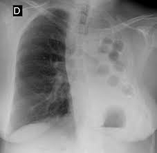Plombage Lucite Spheres Radiology Case Radiopaedia Org Radiology Medical Practice Medical