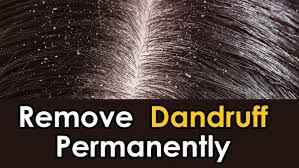 How to remove dandruff quickly. How To Remove Dandruff Permanently Quora