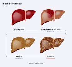 Fatty liver treatment