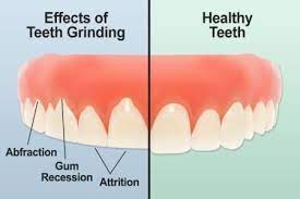 Grinding Of Teeth In Night Know More About It By Dr Arunima Chandra Lybrate