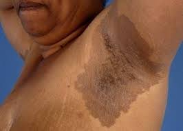 Image result for Erythrasma