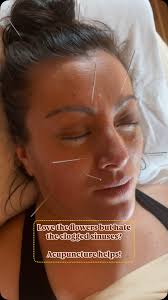 Springtime… Amirite?, Acupuncture can help you with your: runny or Stuffy  noses, Itchy and Watery Eyes, Headaches, Sinus Pressure, and More!, It’s  also a time when we see more jaw and joint pain. ...