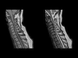 Mri cervical spine and mri shoulder for pain indications. Phoenix Gallery