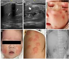 Image result for Allergic Colitis of Infancy