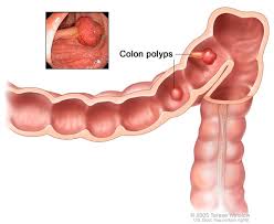 If you're still on the fence about taking the colonoscopy plunge, just think about it like this: Lynch Syndrome Medlineplus Genetics