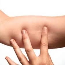 Quitar Implante Anticonceptivo Brazo Implanon Arpa Medica