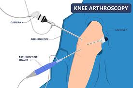 Anterior Cruciate Ligament Injury: Causes, Diagnosis, and ...