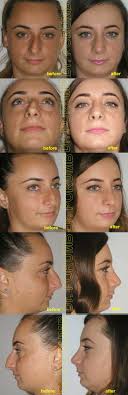 Recomandari clinici private bucuresti pentru operatia de deviatie de sept? Rinoplastie Septoplastie ClinicÄƒ ExclusivistÄƒ La Standarde Occidentale