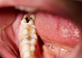 A dead tooth will often darken. Dead Tooth Symptoms Causes And Treatment