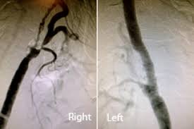 Image result for Jaw Claudication