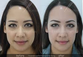 Sometimes you can dream of having slim face but chubby face are more attractive. Facial Reshaping And Facial Slimming Facelove